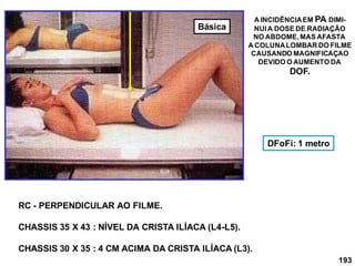 193
RC - PERPENDICULAR AO FILME.
CHASSIS 35 X 43 : NÍVEL DA CRISTA ILÍACA (L4-L5).
CHASSIS 30 X 35 : 4 CM ACIMA DA CRISTA ILÍACA (L3).
A INCIDÊNCIAEM PA DIMI-
NUIA DOSE DE RADIAÇÃO
NO ABDOME,MAS AFASTA
A COLUNALOMBAR DO FILME
CAUSANDO MAGNIFICAÇAO
DEVIDO O AUMENTO DA
DOF.
DFoFi: 1 metro
Básica
 