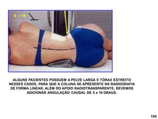 195
5 - 10
ALGUNS PACIENTES POSSUEM A PELVE LARGA E TÓRAX ESTREITO
NESSES CASOS, PARA QUE A COLUNA SE APRESENTE NA RADIOGRAFIA
DE FORMA LINEAR, ALÉM DO APOIO RADIOTRANSPARENTE, DEVEMOS
ADICIONAR ANGULAÇÃO CAUDAL DE 5 a 10 GRAUS.
 