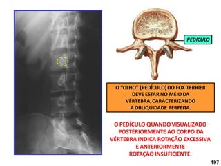 197
O “OLHO” (PEDÍCULO)DO FOX TERRIER
DEVE ESTAR NO MEIO DA
VÉRTEBRA,CARACTERIZANDO
A OBLIQUIDADE PERFEITA.
O PEDÍCULO QUANDOVISUALIZADO
POSTERIORMENTE AO CORPO DA
VÉRTEBRA INDICA ROTAÇÃO EXCESSIVA
E ANTERIORMENTE
ROTAÇÃO INSUFICIENTE.
PEDÍCULO
 