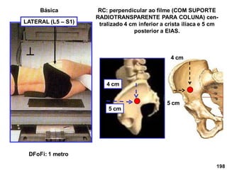 198
LATERAL (L5 – S1)
RC: perpendicular ao filme (COM SUPORTE
RADIOTRANSPARENTE PARA COLUNA) cen-
tralizado 4 cm inferior a crista ilíaca e 5 cm
posterior a EIAS.
DFoFi: 1 metro
4 cm
5 cm
Básica
5 cm
4 cm
 