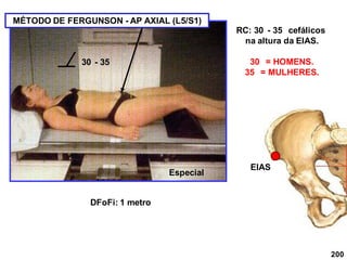 200
RC: 30 - 35 cefálicos
na altura da EIAS.
30 = HOMENS.
35 = MULHERES.
DFoFi: 1 metro
EIAS
30 - 35
Especial
MÉTODO DE FERGUNSON - AP AXIAL (L5/S1)
 
