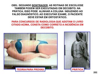 202
OBS.: SEGUNDO BONTRAGER, AS ROTINAS DE ESCOLIOSE
TAMBÉM PODEM SER EXECUTADAS EM DECÚBITO. NA
PRÁTICA, ISSO PODE ALINHAR A COLUNA INDUZINDO AO
FALSO DIAGNÓSTICO. AO EXECUTAR EXAME, O PACIENTE
DEVE ESTAR EM ORTOSTÁTICO.
PARA CONCURSOS DE RADIOLOGIA QUE ADOTAM O LIVRO
CITADO ACIMA, CONSTA COMO CORRETO A INCIDÊNCIA EM
DECÚBITO.
TEORIA PARA PROVAS PRÁTICA
 