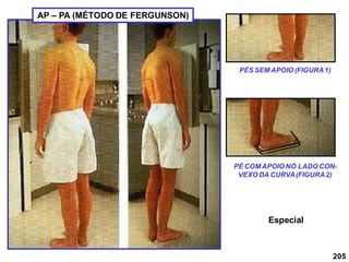 205
PÉS SEM APOIO (FIGURA1)
PÉ COM APOIO NO LADO CON-
VEXO DA CURVA(FIGURA2)
AP – PA (MÉTODO DE FERGUNSON)
Especial
 