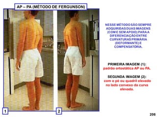 206
NESSE MÉTODOSÃO SEMPRE
ADQUIRIDASDUAS IMAGENS
(COM E SEM APOIO) PARAA
DIFERENCIAÇÃO ENTRE
CURVATURAS PRIMÁRIA
(DEFORMANTE)E
COMPENSATÓRIA.
PRIMEIRA IMAGEM (1):
padrão ortostática AP ou PA.
SEGUNDA IMAGEM (2):
com o pé ou quadril elevado
no lado convexo da curva
elevada.
1 2
AP – PA (MÉTODO DE FERGUNSON)
 