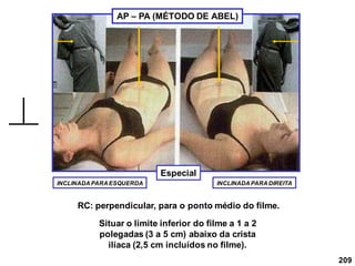 209
INCLINADA PARA ESQUERDA INCLINADA PARA DIREITA
RC: perpendicular, para o ponto médio do filme.
AP – PA (MÉTODO DE ABEL)
Situar o limite inferior do filme a 1 a 2
polegadas (3 a 5 cm) abaixo da crista
ilíaca (2,5 cm incluídos no filme).
Especial
 