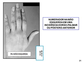 NUMERADOR NAMÃO
ESQUERDAEM UMA
INCIDÊNCIADORSO-PALMAR
OU PÓSTERO-ANTERIOR
21
 