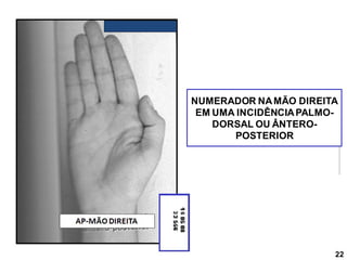NUMERADOR NAMÃO DIREITA
EM UMA INCIDÊNCIAPALMO-
DORSAL OU ÂNTERO-
POSTERIOR
22
 