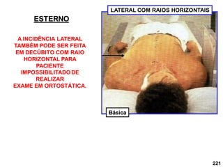 221
LATERAL COM RAIOS HORIZONTAIS
ESTERNO
A INCIDÊNCIA LATERAL
TAMBÉM PODE SER FEITA
EM DECÚBITO COM RAIO
HORIZONTAL PARA
PACIENTE
IMPOSSIBILITADO DE
REALIZAR
EXAME EM ORTOSTÁTICA.
Básica
 