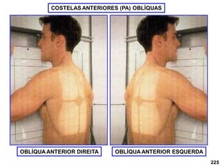 225
COSTELAS ANTERIORES (PA) OBLÍQUAS
OBLÍQUA ANTERIOR DIREITA OBLÍQUA ANTERIOR ESQUERDA
 