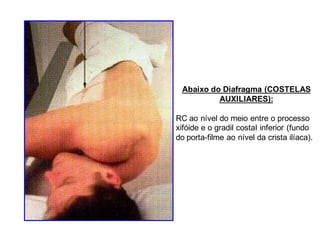 Abaixo do Diafragma (COSTELAS
AUXILIARES):
RC ao nível do meio entre o processo
xifóide e o gradil costaI inferior (fundo
do porta-filme ao nível da crista ilíaca).
 