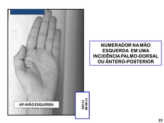 NUMERADOR NAMÃO
ESQUERDA EM UMA
INCIDÊNCIAPALMO-DORSAL
OU ÂNTERO-POSTERIOR
23
 