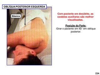 Com paciente em decúbito, as
costelas auxiliares são melhor
visualisadas.
OBLÍQUA POSTERIOR ESQUERDA
Posição da Parte:
Girar o paciente em 45 em oblíqua
posterior.
234
Básica
 