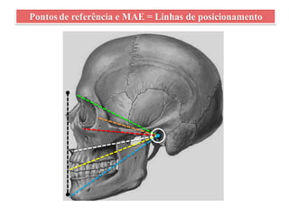 Pontos de referência e MAE = Linhas de posicionamento
 