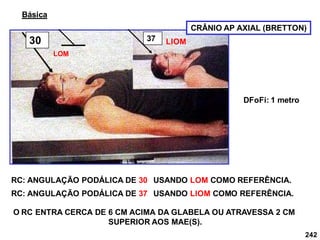 242
RC: ANGULAÇÃO PODÁLICA DE 30 USANDO LOM COMO REFERÊNCIA.
RC: ANGULAÇÃO PODÁLICA DE 37 USANDO LIOM COMO REFERÊNCIA.
O RC ENTRA CERCA DE 6 CM ACIMA DA GLABELA OU ATRAVESSA 2 CM
SUPERIOR AOS MAE(S).
Básica
DFoFi: 1 metro
30 37
CRÂNIO AP AXIAL (BRETTON)
LOM
LIOM
 