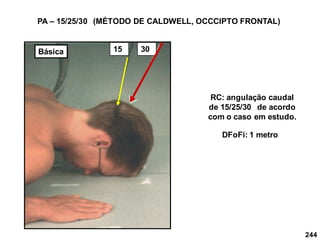 244
PA – 15/25/30 (MÉTODO DE CALDWELL, OCCCIPTO FRONTAL)
RC: angulação caudal
de 15/25/30 de acordo
com o caso em estudo.
DFoFi: 1 metro
30
15
Básica
 