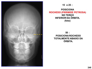246
15 e 25 :
POSICIONA
ROCHEDO (PIRÂMIDE PETROSA)
NO TERÇO
INFERIOR DA ÓRBITA.
(foto)
50 :
POSICIONA ROCHEDO
TOTALMENTE ABAIXO DA
ÓRBITA.
 