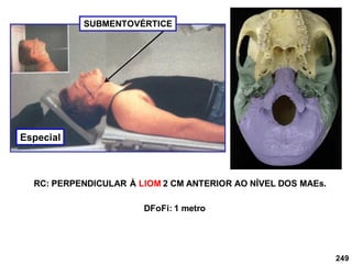 249
SUBMENTOVÉRTICE
RC: PERPENDICULAR À LIOM 2 CM ANTERIOR AO NÍVEL DOS MAEs.
DFoFi: 1 metro
Especial
 