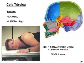 251
Cela Túrcica
Básicas:
• AP AXIAL;
• LATERAL (fig.).
RC: ┴ 2 CM ANTERIOR e 2 CM
SUPERIOR AO MAE.
DFoFi: 1 metro
 