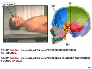 252
AP AXIAL
RC: 37º CAUDAL em relação à LOM para PROCESSOS CLINÓIDES ANTERIORES
e DORSO DA SELA.
RC: 30º CAUDAL em relação à LOM para PROCESSSOS CLINÓIDES
ANTERIORES.
37º
37º
30º
 