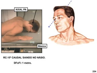 254
AXIAL PA
RC:15º CAUDAL SAINDO NO NÁSIO.
DFoFi: 1 metro.
Básica
 