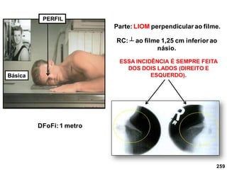 259
PERFIL
Parte: LIOM perpendicular ao filme.
RC: ┴ ao filme 1,25 cm inferior ao
násio.
DFoFi:1 metro
ESSA INCIDÊNCIA É SEMPRE FEITA
DOS DOIS LADOS (DIREITO E
ESQUERDO).
Básica
 