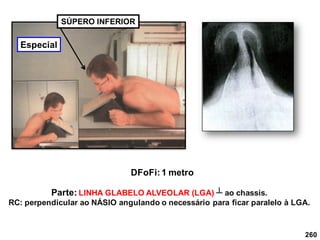 SÚPERO INFERIOR
DFoFi:1 metro
260
Parte: LINHA GLABELO ALVEOLAR (LGA) ┴ ao chassis.
RC: perpendicular ao NÁSIO angulando o necessário para ficar paralelo à LGA.
Especial
 