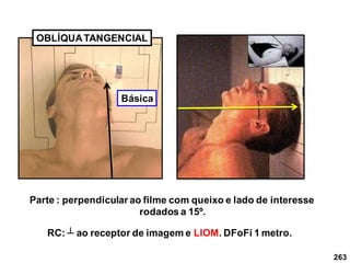 263
OBLÍQUATANGENCIAL
Parte : perpendicular ao filme com queixo e lado de interesse
rodados a 15º.
RC: ┴ ao receptor de imagem e LIOM. DFoFi 1 metro.
Básica
 
