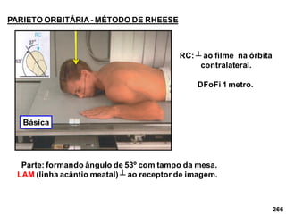 266
PARIETO ORBITÁRIA- MÉTODO DE RHEESE
Parte: formando ângulo de 53º com tampo da mesa.
LAM (linha acântio meatal) ┴ ao receptor de imagem.
RC: ┴ ao filme na órbita
contralateral.
DFoFi 1 metro.
Básica
 