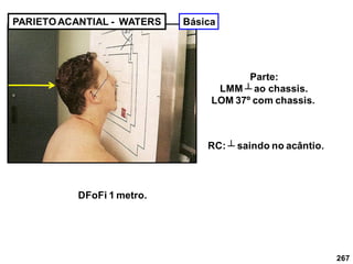 267
PARIETOACANTIAL - WATERS
Parte:
LMM ┴ ao chassis.
LOM 37º com chassis.
RC: ┴ saindo no acântio.
DFoFi 1 metro.
Básica
 