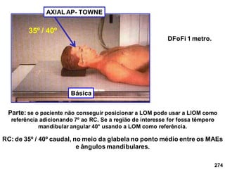 274
AXIAL AP- TOWNE
Parte: se o paciente não conseguir posicionar a LOM pode usar a LIOM como
referência adicionando 7º ao RC. Se a região de interesse for fossa têmporo
mandibular angular 40° usando a LOM como referência.
RC: de 35º / 40º caudal, no meio da glabela no ponto médio entre os MAEs
e ângulos mandibulares.
DFoFi 1 metro.
35º / 40º
Básica
 