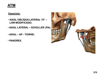 276
ATM
Especiais:
• AXIAL OBLÍQUA LATERAL 15° –
LAW MODIFICADO;
• AXIAL LATERAL – SCHULLER (PA);
• AXIAL – AP - TOWNE;
• PANOREX.
 