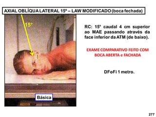 277
AXIAL OBLÍQUALATERAL 15º – LAW MODIFICADO(boca fechada)
RC: 15° caudal 4 cm superior
ao MAE passando através da
face inferior daATM (de baixo).
EXAMECOMPARATIVO FEITO COM
BOCA ABERTA e FACHADA
DFoFi 1 metro.
15°
Básica
 