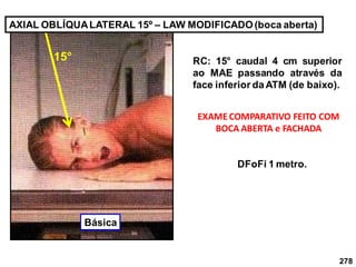 278
AXIAL OBLÍQUALATERAL 15º – LAW MODIFICADO(boca aberta)
RC: 15° caudal 4 cm superior
ao MAE passando através da
face inferior daATM (de baixo).
EXAMECOMPARATIVO FEITO COM
BOCA ABERTA e FACHADA
DFoFi 1 metro.
15°
Básica
 