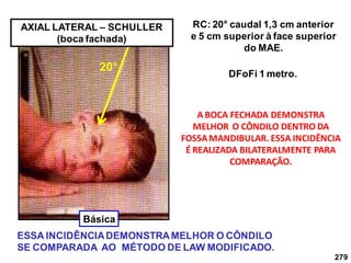 279
AXIAL LATERAL – SCHULLER
(boca fachada)
RC: 20° caudal 1,3 cm anterior
e 5 cm superior à face superior
do MAE.
DFoFi 1 metro.
A BOCA FECHADA DEMONSTRA
MELHOR O CÔNDILO DENTRO DA
FOSSAMANDIBULAR. ESSA INCIDÊNCIA
É REALIZADA BILATERALMENTE PARA
COMPARAÇÃO.
ESSA INCIDÊNCIADEMONSTRAMELHOR O CÔNDILO
SE COMPARADA AO MÉTODO DE LAW MODIFICADO.
20°
Básica
 