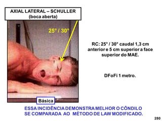 280
DFoFi 1 metro.
RC: 25° / 30° caudal 1,3 cm
anterior e 5 cm superior a face
superior do MAE.
ESSA INCIDÊNCIADEMONSTRAMELHOR O CÔNDILO
SE COMPARADA AO MÉTODO DE LAW MODIFICADO.
25° / 30°
AXIAL LATERAL – SCHULLER
(boca aberta)
Básica
 