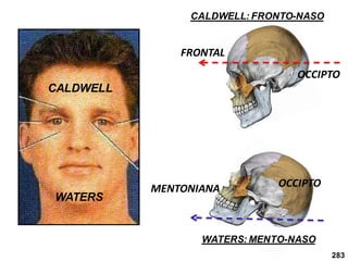283
WATERS
CALDWELL
OCCIPTO
MENTONIANA
WATERS: MENTO-NASO
OCCIPTO
FRONTAL
CALDWELL: FRONTO-NASO
 