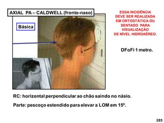 285
AXIAL PA – CALDWELL (fronto-naso)
DFoFi 1 metro.
RC: horizontal perpendicular ao chão saindo no násio.
Parte: pescoço estendido para elevar a LOM em 15º.
ESSA INCIDÊNCIA
DEVE SER REALIZADA
EM ORTOSTÁTICA OU
SENTADO PARA
VISUALIZAÇÃO
DE NÍVEL HIDROAÉREO.
Básica
 