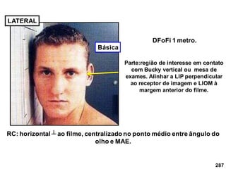 287
LATERAL
DFoFi 1 metro.
RC: horizontal ┴ ao filme, centralizado no ponto médio entre ângulo do
olho e MAE.
Parte:região de interesse em contato
com Bucky vertical ou mesa de
exames. Alinhar a LIP perpendicular
ao receptor de imagem e LIOM à
margem anterior do filme.
Básica
 