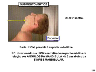 288
SUBMENTOVÉRTICE
DFoFi 1 metro.
RC: direcionado ┴ à LIOM centralizado no ponto médio em
relação aos ÂNGULOS DA MANDÍBULA 4 / 5 cm abaixo da
SÍNFISE MANDIBULAR.
Parte: LIOM paralela à superfície do filme.
Especial
 