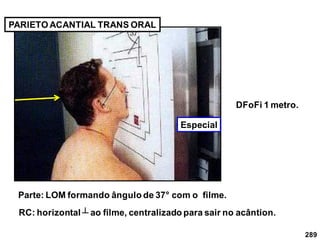 289
PARIETO ACANTIAL TRANS ORAL
Parte: LOM formando ângulo de 37° com o filme.
DFoFi 1 metro.
RC: horizontal ┴ ao filme, centralizado para sair no acântion.
Especial
 