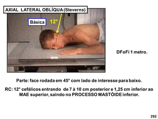 292
AXIAL LATERAL OBLÍQUA(Steverns)
Parte: face rodada em 45° com lado de interesse para baixo.
RC: 12° cefálicos entrando de 7 à 10 cm posterior e 1,25 cm inferior ao
MAE superior, saindo no PROCESSO MASTÓIDEinferior.
DFoFi 1 metro.
12°
Básica
 