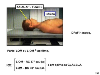 293
AXIAL AP - TOWNE
Parte: LOM ou LIOM ┴ ao filme.
LIOM – RC 37° caudal.
LOM – RC 30° caudal.
RC: 5 cm acima da GLABELA.
DFoFi 1 metro.
Básica
 
