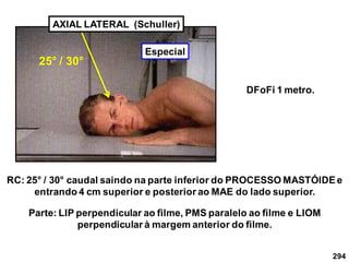 294
AXIAL LATERAL (Schuller)
RC: 25° / 30° caudal saindo na parte inferior do PROCESSO MASTÓIDEe
entrando 4 cm superior e posterior ao MAE do lado superior.
25° / 30°
DFoFi 1 metro.
Parte: LIP perpendicular ao filme, PMS paralelo ao filme e LIOM
perpendicular à margem anterior do filme.
Especial
 