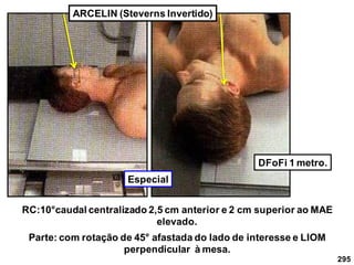 295
ARCELIN (Steverns Invertido)
RC:10°caudal centralizado 2,5 cm anterior e 2 cm superior ao MAE
elevado.
Parte: com rotação de 45° afastada do lado de interesse e LIOM
perpendicular à mesa.
DFoFi 1 metro.
Especial
 