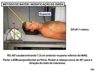 296
MÉTODO DE MAYER / MODIFICAÇÃO DE OWEN
Parte: LIOM perpendicular ao filme. Rodar a cabeça cerca de 45° para a
direção do lado de interesse.
RC:45°caudal entrando 7,5 cm anterior na parte inferior do MAE.
DFoFi 1 metro.
Especial
 