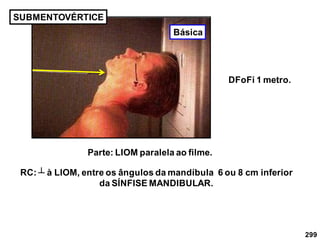 299
SUBMENTOVÉRTICE
RC: ┴ à LIOM, entre os ângulos da mandíbula 6 ou 8 cm inferior
da SÍNFISE MANDIBULAR.
Parte: LIOM paralela ao filme.
DFoFi 1 metro.
Básica
 