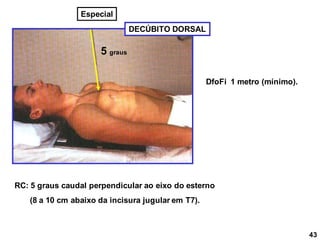 DECÚBITO DORSAL
RC: 5 graus caudal perpendicular ao eixo do esterno
(8 a 10 cm abaixo da incisura jugular em T7).
DfoFi 1 metro (mínimo).
43
Especial
5 graus
 