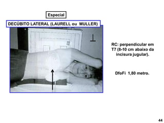 DECÚBITO LATERAL (LAURELL ou MULLER)
RC: perpendicular em
T7 (8-10 cm abaixo da
incisura jugular).
DfoFi 1,80 metro.
44
Especial
 