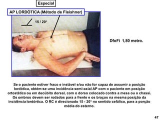 47
AP LORDÓTICA (Método de Fleishner)
Se o paciente estiver fraco e instável e/ou não for capaz de assumir a posição
lordótica, obtém-se uma incidência semi-axial AP com o paciente em posição
ortostática ou em decúbito dorsal, com o dorso colocado contra a mesa ou o chassi.
Os ombros devem ser rodados para a frente e os braços na mesma posição da
incidência lordórtica. O RC é direcionado 15 - 20 no sentido cefálico, para a porção
média do esterno.
15 / 20
DfoFi 1,80 metro.
Especial
 