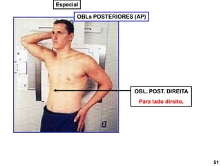 OBLs POSTERIORES (AP)
OBL. POST. DIREITA
Para lado direito.
51
Especial
 